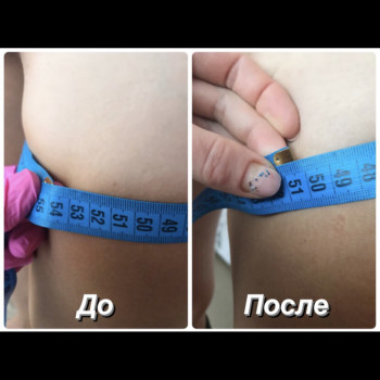 После 1 процедуры Slimbody