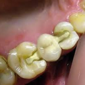 Адгезивный мостовидный протез
   #