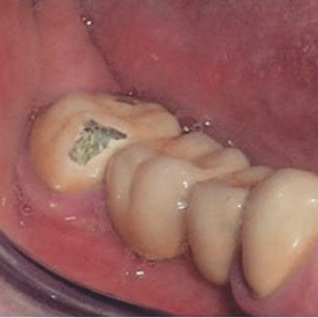 Скол керамического покрытия искусственной коронки
   #