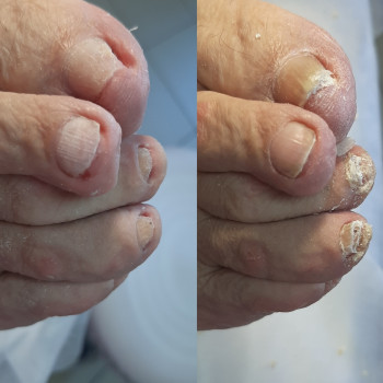 Робота з грибковим нігтем
                    Подолог Татьяна Викторовна Запорожье