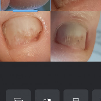 Робота з грибковим нігтем
                    Подолог Татьяна Викторовна Запорожье