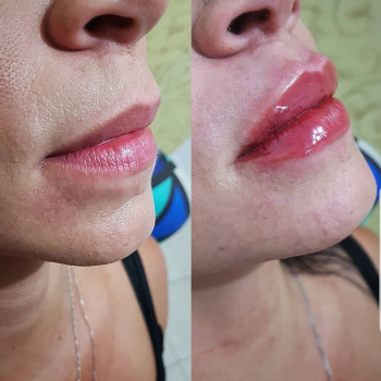 Аугментация губ
                    Косметолог Лариса Игнатьева Одесса