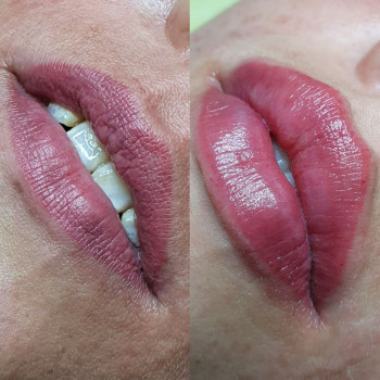 Аугментация губ
                    Косметолог Лариса Игнатьева Одесса