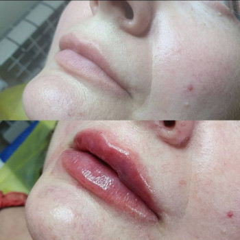 Аугментация губ
                    Косметолог Лариса Игнатьева Одесса