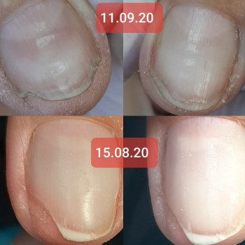 Робота з грибковим нігтем
                    Подолог Татьяна Викторовна Запорожье