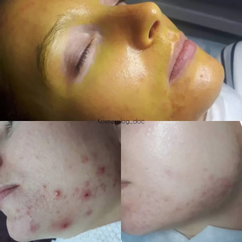 Жёлтый (ретиноловый) пилинг
                    Косметолог-инъекционист Ирина Херсон