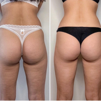 Антицелюлітний масаж
                    Массажист Александр Киев