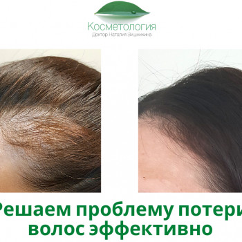 Плазмолифтинг волос
                    Косметологический центр Косметология Наталии Вишникиной Киев