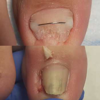 Коррекція врослого нігтя
                    Подолог Татьяна Викторовна Запорожье