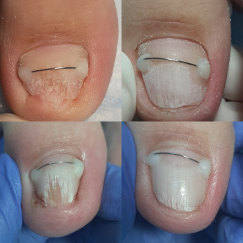 Робота з грибковим нігтем
                    Подолог Татьяна Викторовна Запорожье