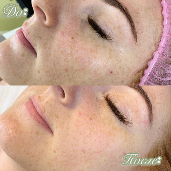 Процедура отбеливания, пилинг