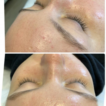 Вишнёвый пилинг anti-aсne