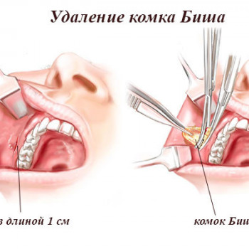 В чём заключаеться сама операция.