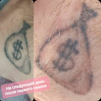 Удаление тату лазером
                    Косметолог Максим Дніпро