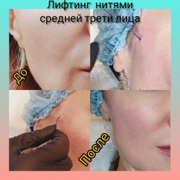 Подтяжка средней трети лица мезонитями. 
Используются нити к