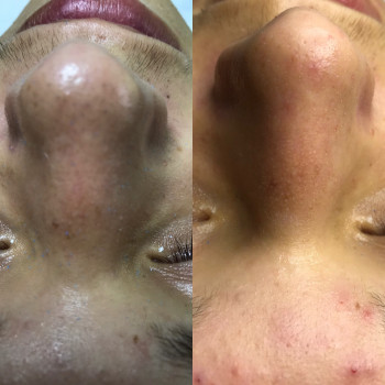 Комбинированная чистка лица