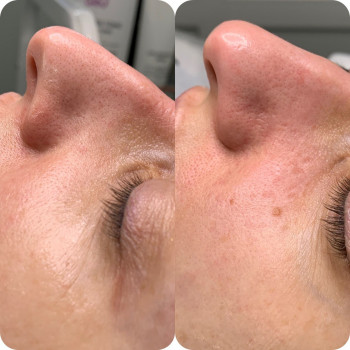 Атравматичная чистка лица