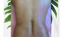 Безоперационная липосакция на аппарате velashape 4 Косметологический центр Lab Kharkov Харьков