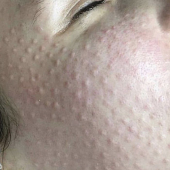 Хімічний пілінг
                    Студия татуажа Permanent face Ивано-Франковск