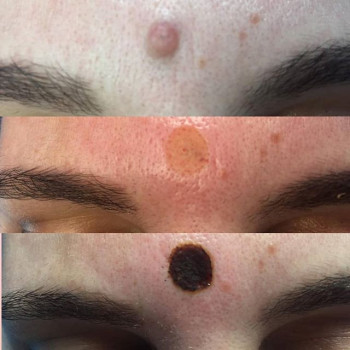 Удаление папиллом на лице
                    Косметологічний центр Медсервис Дніпро