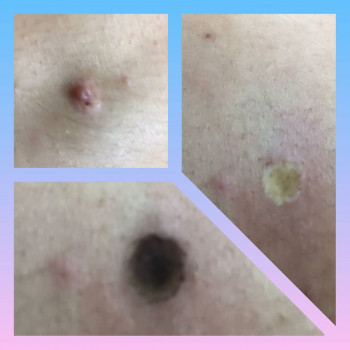 Удаление папиллом на лице
                    Косметологічний центр Медсервис Дніпро