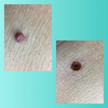 Удаление папиллом на лице
                    Косметологічний центр Медсервис Дніпро