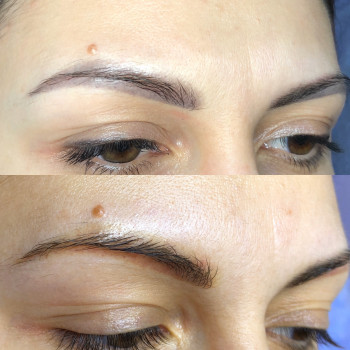 Лазерное удаление тату и татуажа
                    Салон краси Confetti Харків