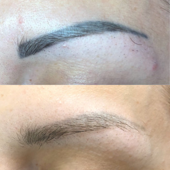 Лазерное удаление тату и татуажа
                    Салон краси Confetti Харків