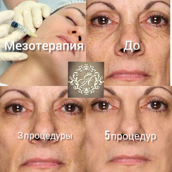 Мезотерапия, биоревитализации
                    Майстер перманентного макіяжу Татьяна Миколаїв