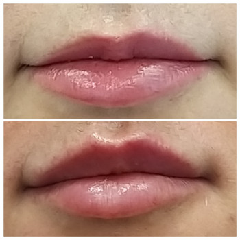 Увеличение объёма и коррекция асимметрия губ филлером Белоте