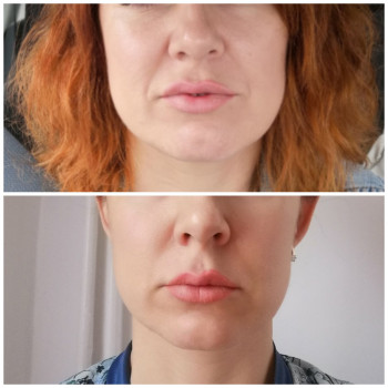 Коррекция средней трети лица и заполнение носогубных складок