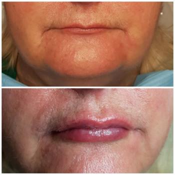 Увеличение губ, филлер Белотеро Баланс 1 мл.