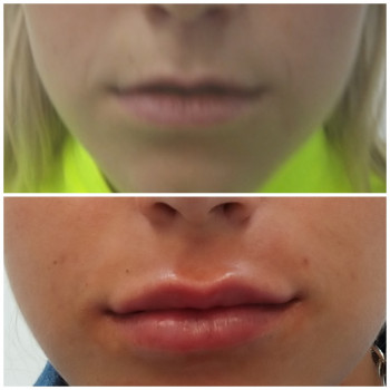 Коррекция обьема и формы губ в 2 этапа.