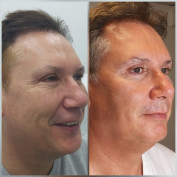 Лифтинговый филлер Радиесс, 3 мл. Результат до- и через 3 ме