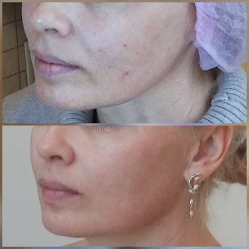 Лифтинговый филлер Радиесс, 3 мл.
Результат до- и через 3 ме