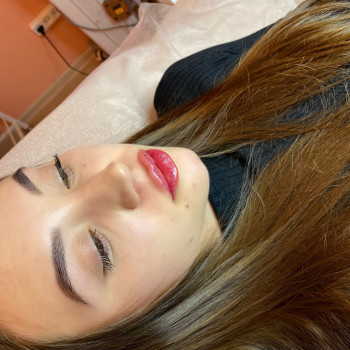 Первичное Увеличение губ