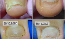 Зачистка онихомикоза Подолог Ольга Бровары