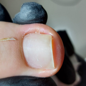 Работа с вросшим ногтем
                    Подолог Ольга Бровары