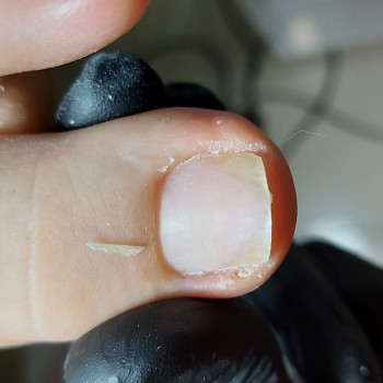 Работа с вросшим ногтем
                    Подолог Ольга Бровары