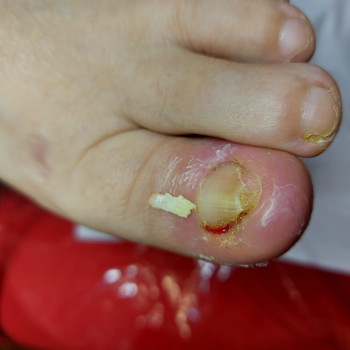 Работа с вросшим ногтем
                    Подолог Ольга Бровары