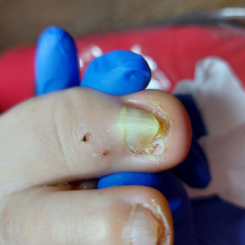 Работа с вросшим ногтем
                    Подолог Ольга Бровары