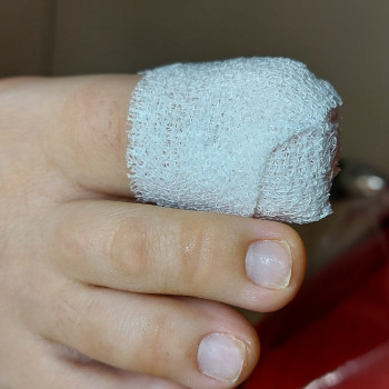 Работа с вросшим ногтем
                    Подолог Ольга Бровары