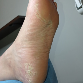 Аппаратный педикюр
                    Подолог Ольга Одесса