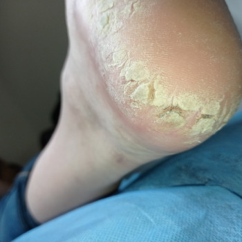 Аппаратный педикюр
                    Подолог Ольга Одесса