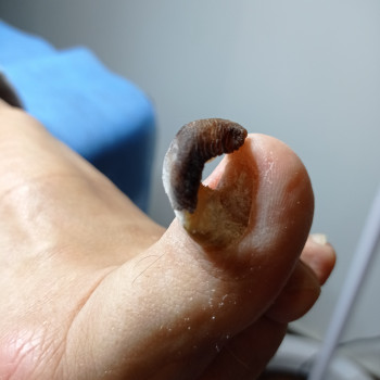 Обработка грибковых ногтей
                    Подолог Ольга Одесса