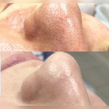 Чистки лица
                    Косметолог Ксения Кропивницкий