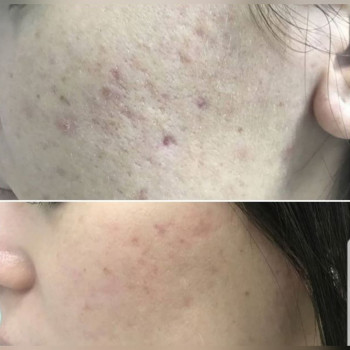 Пилинг
                    Косметолог Ксения Кропивницкий