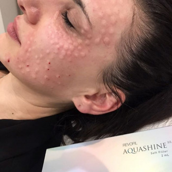 Біоревіталізація
                    Косметолог Ксения Кропивницький