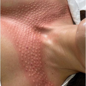 Омолодження зони, глибокого декольте📌