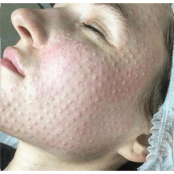 Біоревіталізація
                    Косметолог Ксения Кропивницький